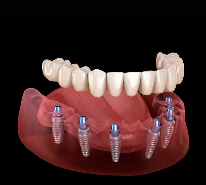 Cirurgia e Implantes