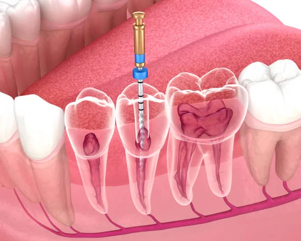 Caso de Endodontia