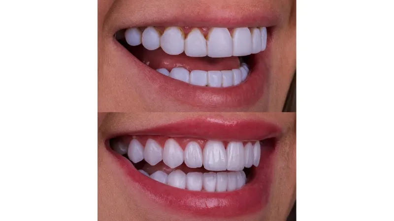 Caso 01 - Estética Dental
