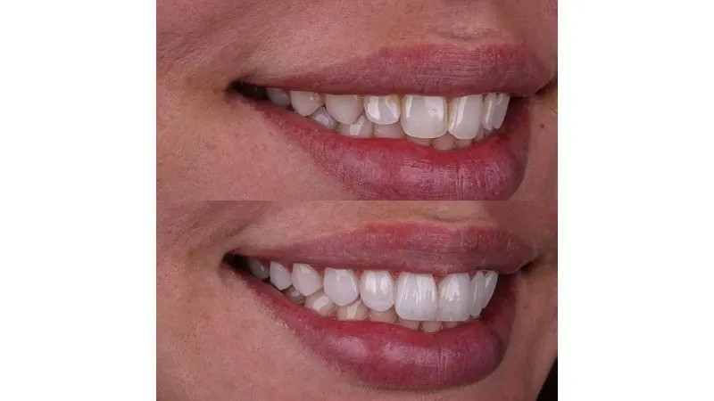 Caso 02 - Estética Dental
