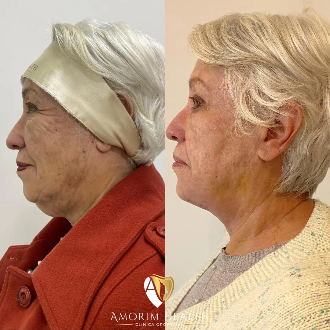 Harmonização Facial